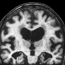 Scansione MRI del cervello
