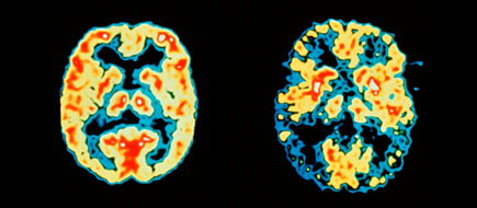 Cerebro normal en comparación con el cerebro de Alzheimer